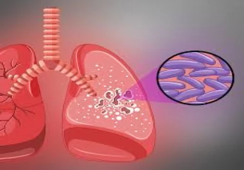 Unique drug delivery method to improve treatment of brain tuberculosis